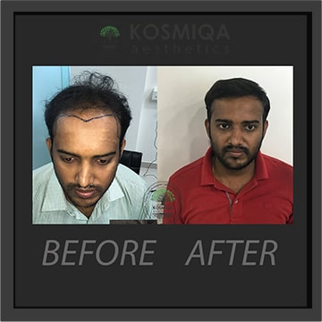 Hair Transplant Trusted  Best Hair Transplant Clinic in India
